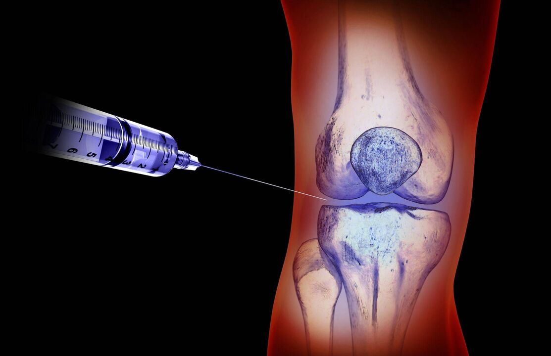 iniezioni intra-articolari per l'osteoartrosi