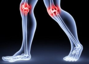 Le ragioni dello sviluppo dell'osteoartrosi del ginocchio