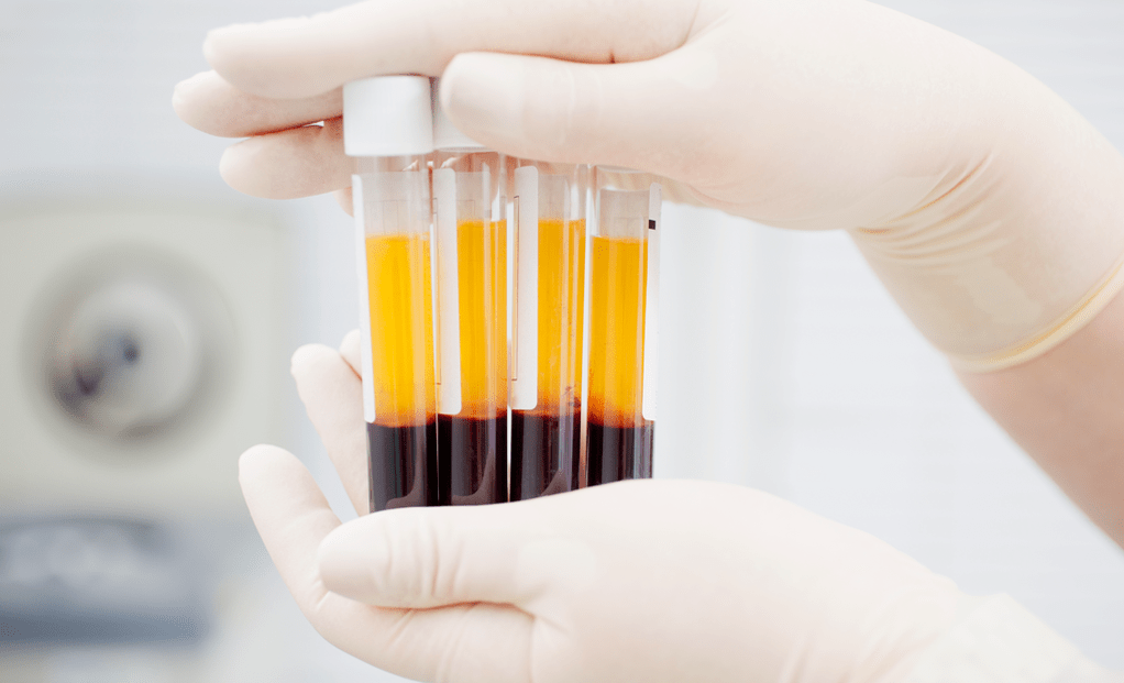 Plasma ricco di piastrine per la terapia PRP per l'osteoartrosi